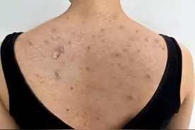 后背螨虫痘痘终于有救了！过来人的方法就是好，轻松逆袭白嫩肌肤图片