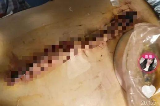 女子被家暴16次，需终身挂粪袋一案，最新进展：前婆婆被判返还91万余元