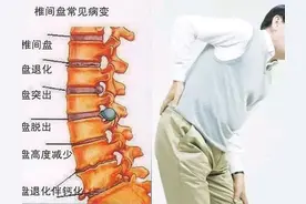 腰椎间盘突出痊愈实录图片