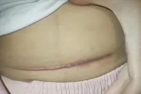 花了3个月时间，剖腹产疤痕终于没了！血泪经验分享！图片