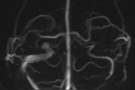 30分钟终结4年”心跳耳鸣”哈医大一院创新局麻手术破解顽固耳鸣图片