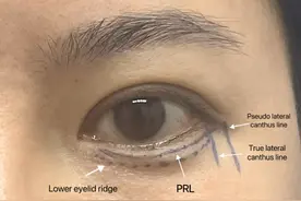 田鑫医生为你解析“卧蚕”注射图片