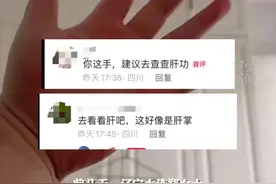 大连郑女士手红疑肝病，抖音网友神预言！图片