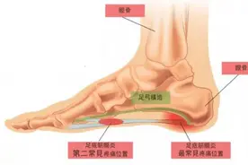 足跟痛常见，原因？怎么应对？图片