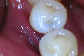 牙齿内隐隐发黑，咋回事？蛀了呗，“虫”哪里进去的？看第三张图图片