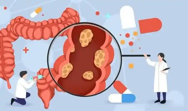 大便是结肠癌最好的“预警”!提示:出现这3个异常,多半是肠癌