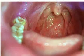 慢性咽炎的用药指导！你能记全吗？图片