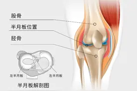 半月板损伤怎么办？预防方法&恢复秘籍！图片