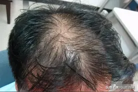 血虚脱发，肝肾亏白发，湿重头油，3个中成药，拯救头发问题！图片