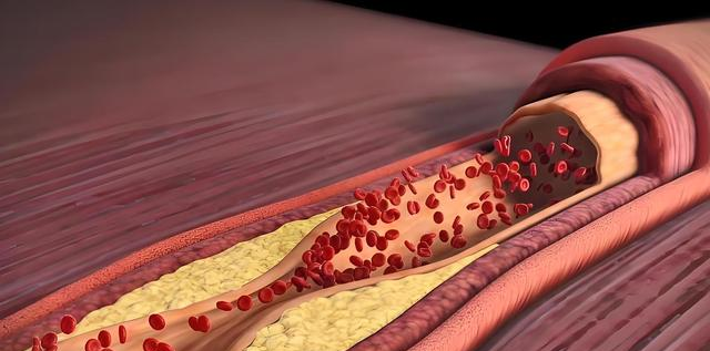 北京协和：高血脂可以做的运动排名？不知道的高血脂患者太亏了！