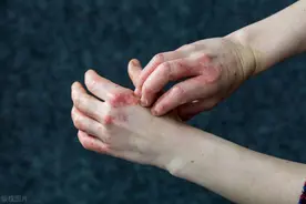 皮肤起疹、溃烂、瘙痒，怎么办？中医帮你改善皮肤问题图片
