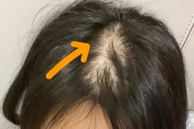 秃头友友自用育发产品测评！防脱生发各有奇效！图片