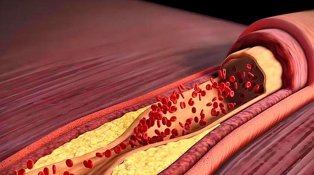 北京协和：高血脂可以做的运动排名，不知道的高血脂患者太亏了！