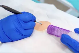 注意！点痣高峰期来了，医生请你“小心点”图片