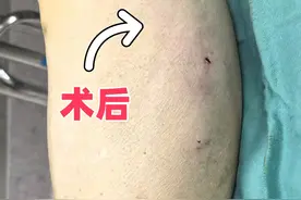 一个人做静脉曲张手术，体验如何？费用多少？术后恢复怎么样？图片