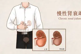 中医外治肾病，疗效“肾”好图片