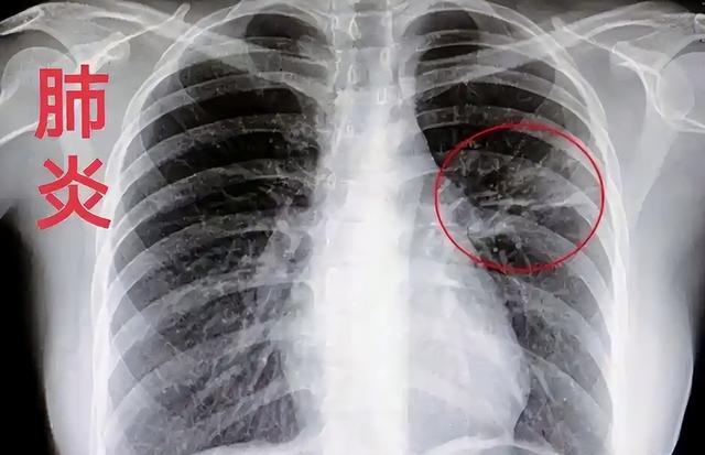 甲流死亡人数持续上涨？告诫：少吃白菜，多吃这几样，提高免疫