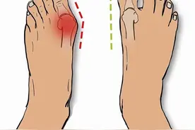 女性脚趾头部位疼痛、红肿、脚趾倾斜，你想要的答案在这图片