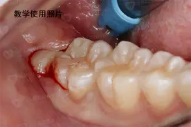 拔牙后血凝块脱落，专家告诉你如何科学处理图片