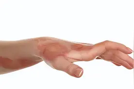 烧伤后别乱处理！专家教你正确的应急处理方法！图片