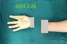 6个小时断腕“重生”！万宁一女子被砍断右手腕陷入昏迷，海医二院多科室协作，再植手术成功图片