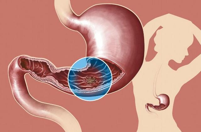 豆腐再次被关注！医生研究：胃酸反流患者常吃豆腐，或出现5改善