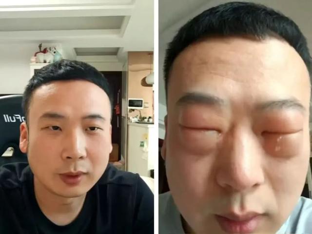 太夸张！男子吃了8颗，仅10分钟眼睛肿成"奥特曼"！医生提醒
