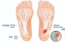 足底筋膜炎的诊断与治疗，看这篇就够了图片