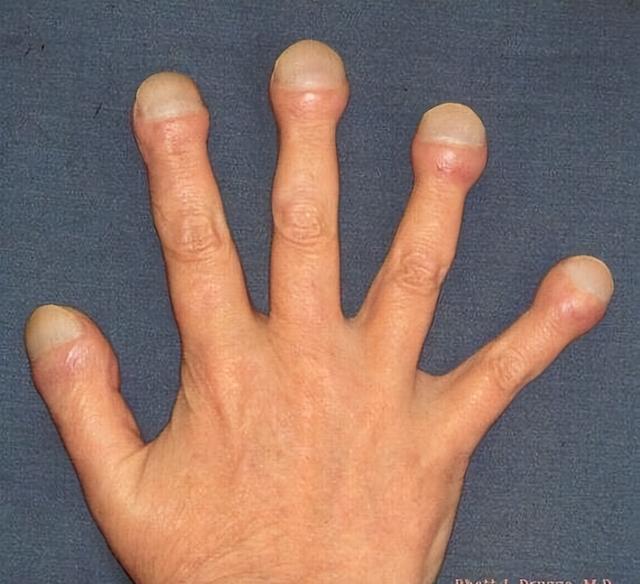 不是皮肤病，而是癌症预警？皮肤出现4种情况	，建议早做检查