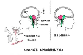 小脑扁桃体下疝畸形图片