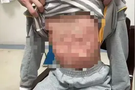 触目惊心！宁波9岁男孩春游后过敏性休克！紧急提醒图片