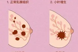 乳腺结节报4a就一定是恶性吗？是否要手术去除图片