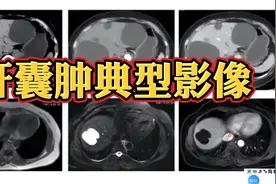 爱长囊肿多半痰湿重，教你3个方法，化痰祛湿，最快半个月就见效图片