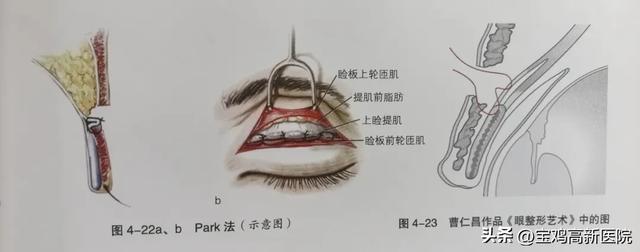 想做双眼皮?请查收这份攻略