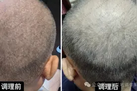 1把花椒洗头，再加一个中药方，把头皮鳞屑根除，银屑病自然好！图片