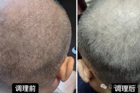 1把花椒洗头，再加一个中药方，把头皮鳞屑根除，银屑病自然好！图片