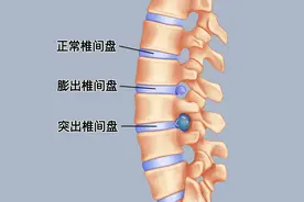 腰突有4级：一级逐瘀、二级祛湿、三级补肾、四级通络！图片