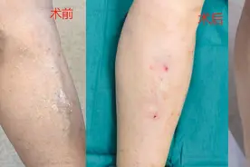 静脉曲张手术不要轻易做！小心3大麻烦找上门，做了没有后悔药图片