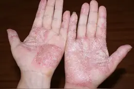 真菌传染速度极快，手癣患者在生活中要注意什么？图片