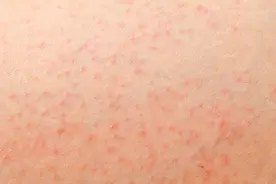 感染梅毒后,会有什么症状？有哪些信号?图片