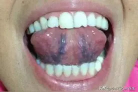 中医教你一招：化瘀先疏肝，疏肝必升阳！疏肝升阳，通全身瘀堵！图片