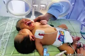2011年，四川孕妇生下中国第一例“双头宝宝”，最后怎么样了？图片