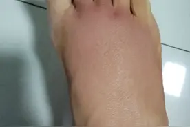我用一天的时间治好了急性脚扭伤图片