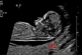 孕妈注意啦，这四大排畸检查时间，千万别错过！图片