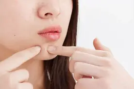 下巴总长痘、痤疮反反复复？可能是这4个原因，日常可以这样预防图片