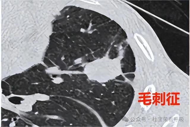 肺结节有以下6个特征,恭喜你:多半是良性的,无需手术切除!