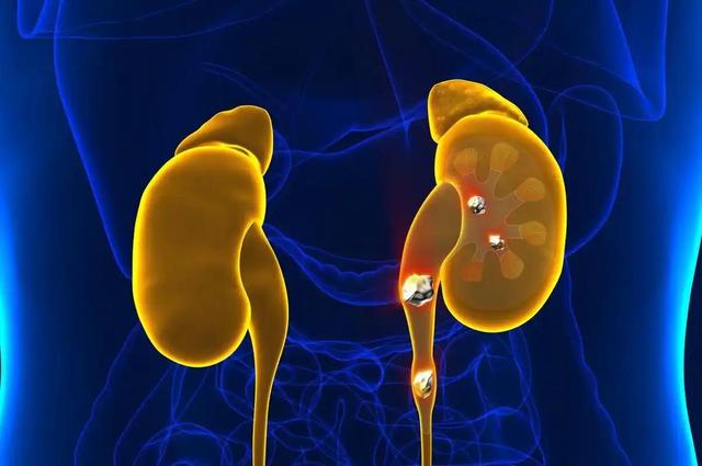 肾结石要戒酒吗？医生提醒：患有肾结石后，饮酒牢记“3不喝”