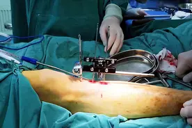 从“截肢危机”到“保肢成功”！和平医院骨科新技术上线图片