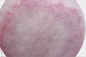 惊！股癣竟然喜欢在这些人身上“安营扎寨”图片