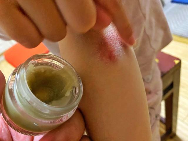 别再乱抹药膏！8种常见皮肤病的“正确治法”，收藏少走弯路